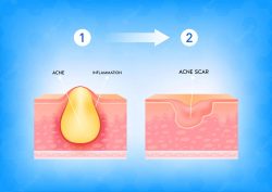 The formation of acne scars and their treatment