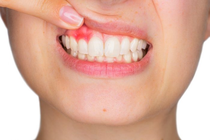 Gum Disease Treatment Specialist | Signs and Symptoms of Gingivitis