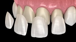 Dental Veneer Cost & Procedure Details – District Dentistry