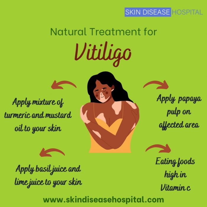 Natural treatment for Vitiligo