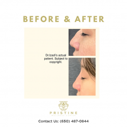 Nose Thread Lift San Ramon