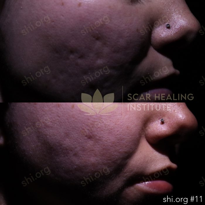 Get the best subcision treatment for acne scars in california