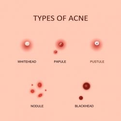 Different types of acne