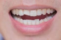 Dental Crown Repair Near Me | Fix Chipped Tooth Repair Cost