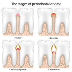 Periodontal Treatment Houston TX | Gum Disease Treatment