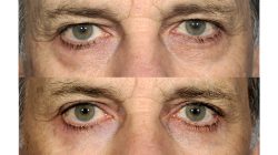 How Much Does Eye Lift Surgery Cost? | Laser Eyelid Surgery