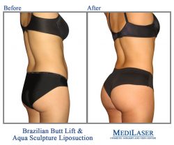 Before and After Pictures of Brazilian Butt Lift | Brazilian Butt Lift Treatment Before and After