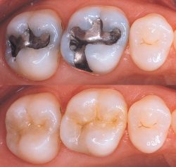 Tooth-Colored Dental Fillings