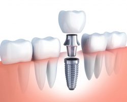 Affordable Root Canal Treatment Near Me