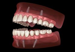 Full Mouth Dental Implants in Houston