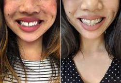 Best Teeth Braces Cost, Types and Benefits | How Much Does Metal Braces Cost?