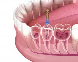 Root Canal Recovery Tips and Post Treatment Care