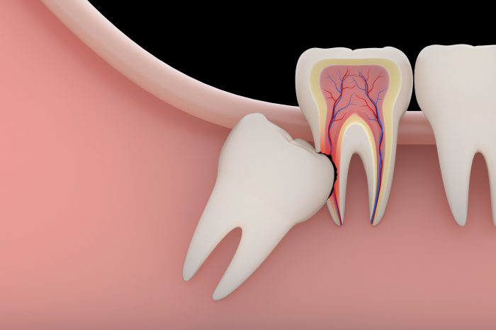 Wisdom Teeth Factory: Affordable Wisdom Teeth Removal