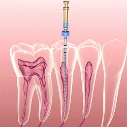 Root Canal In Houston, TX | Root Canal Cost