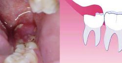 Wisdom Teeth Infection: Symptoms and Treatments