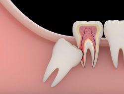 nfected Wisdom Tooth Symptoms| Impacted wisdom tooth Infection