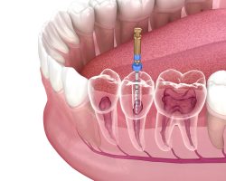 Root Canal Specialist Near Me | Root Canal Treatment Houston TX