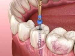 Root Canal Treatment Houston TX