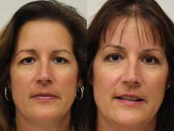 How Much is an Upper Eyelid Lift?