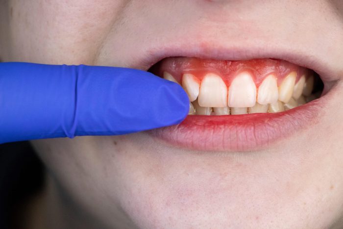 LANAP Treatment Houston TX – Edge Dental | LANAP Dentist Near Me