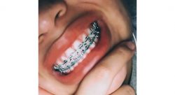 How to Choose the Best Braces Colour for Your Teeth