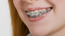 Braces Colors: What Colors are Available and How to Choose