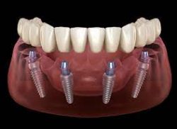 All On 4 Dental Implants Houston TX | All-on-4 Implants Houston, TX | Teeth in a Day
