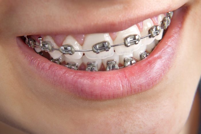 4 Types Of Braces For Teens And Their Costs – Kool Smiles