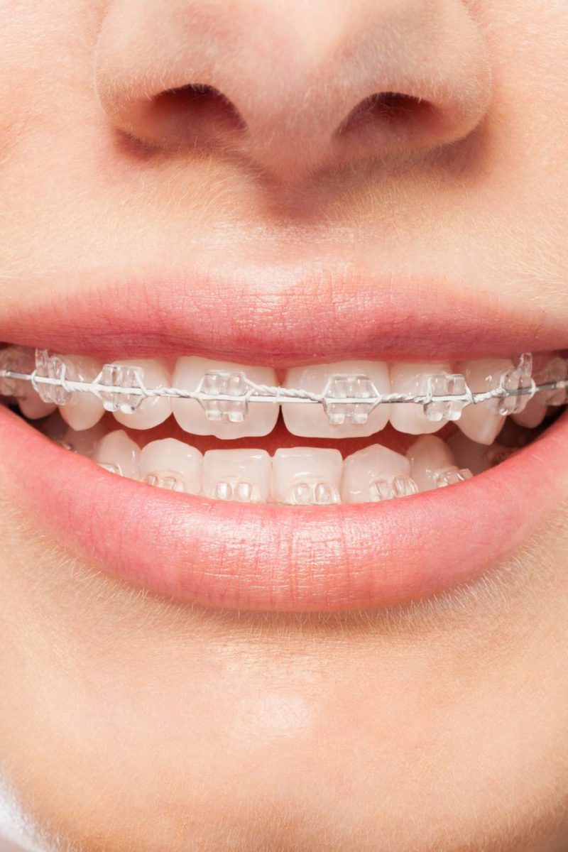 Find an Orthodontist: Clear Braces, Invisible Braces, Aligners