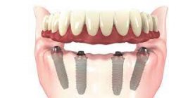 Benefits and Advantages of Dental Implants
