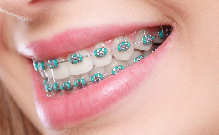 What Is The Average Cost Of Braces In Houston?