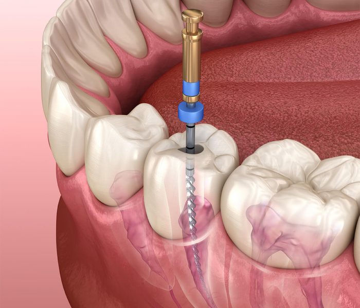 Root Canal Near Me – Houston, TX – Book Appointments Today