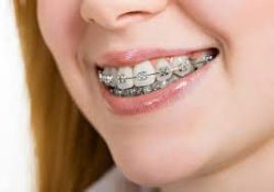 Orthodontic / Braces Treatment – Dental Braces-How do they work – Treatment –  ...