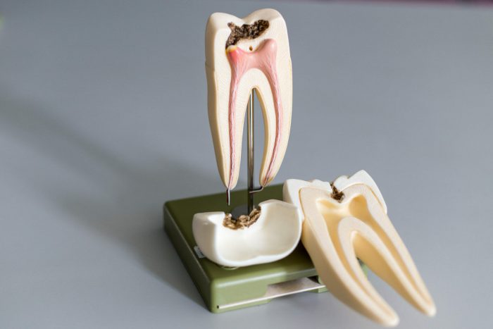 Painless Root Canal Treatment, Single Sitting RCT