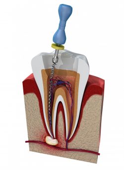Root Canal Specialist Near Me |Locating a Root Canal Specialist