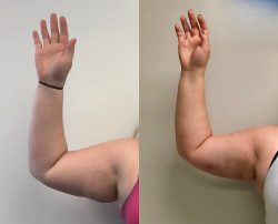 Arm Liposuction Before & After Results
