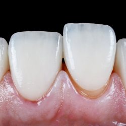 All I want is no-prep veneers, but dentists won’t do it