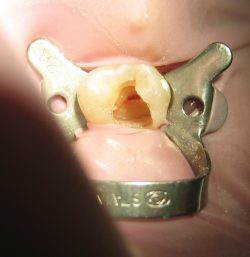 https://epicdentalcenter.com/dental-clinic/root-canal/