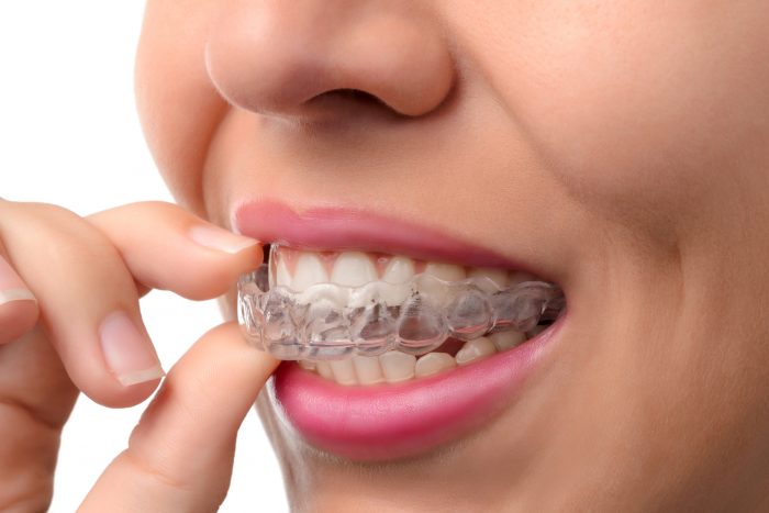 Dentist Invisalign Near Me | Invisalign Before And After Pictures