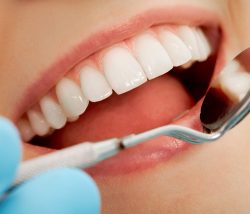Affordable Teeth Whitening Houston – Teeth Bleaching | Teeth Whitening Houston TX