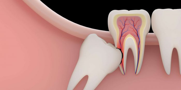 Wisdom Teeth Extraction in Houston, Tx | Low Cost Treatment