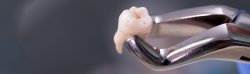 Think You Need an Emergency Tooth Extractio|Emergency Teeth Extraction Near Me