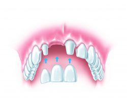 Best Tooth Replacement Options For Missing Teeth
