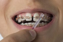 Best Teeth Braces Cost, Types and Benefits