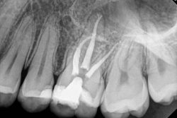 Pain After Root Canal: Root Canal Post-Treatment Care