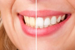 Deepcleaning – Dentist in Miami, FL – Deep Dental Cleaning in Miami, Fl