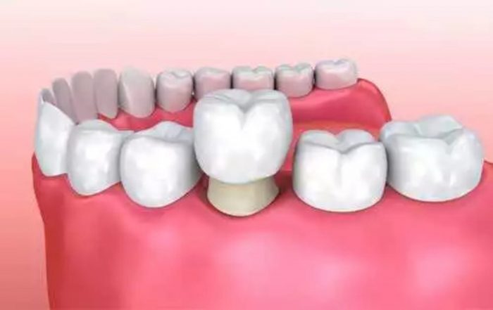 How Dental Crowns will help you?