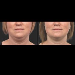 Double Chin Removal Non Surgical | Dermedica