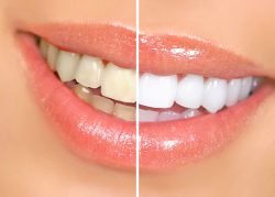 Teeth Whitening Dentist Near Me | Laser Teeth Whitening Cost Houston