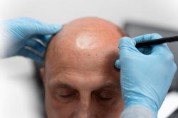 Are You Looking For Best Hair Transplant Clinic In Delhi